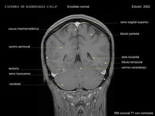CATEDRA DE RADIOLOGIA U.N.L.P.   Encéfalo normal                Edición 2002




                                                       seno sagital superior

  cisura interhemisférica
                                                       lóbulo parietal



  centro semioval


                                                        asta occipital
                                                        lóbulo temporal

  tentorio                                              vermis cerebeloso

  seno transverso


  cerebelo




                                                   RM coronal T1 con contraste
 