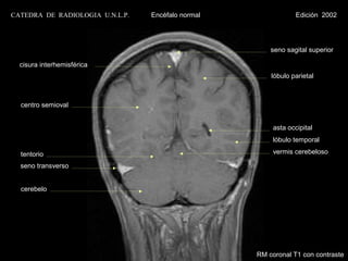 CATEDRA DE RADIOLOGIA U.N.L.P.   Encéfalo normal                Edición 2002




                                                       seno sagital superior

  cisura interhemisférica
                                                       lóbulo parietal



  centro semioval


                                                        asta occipital
                                                        lóbulo temporal

  tentorio                                              vermis cerebeloso

  seno transverso


  cerebelo




                                                   RM coronal T1 con contraste
 
