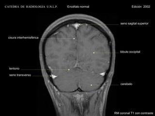 CATEDRA DE RADIOLOGIA U.N.L.P.   Encéfalo normal                Edición 2002




                                                       seno sagital superior



 cisura interhemisférica



                                                       lóbulo occipital




  tentorio

  seno transverso


                                                       cerebelo




                                                   RM coronal T1 con contraste
 