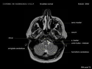 CATEDRA DE RADIOLOGIA U.N.L.P.   Encéfalo normal            Edición 2002




                                                   seno maxilar




                                                   cavum


     clivus
                                                   a. basilar
                                                   unión bulbo - médular

    amígdala cerebelosa
                                                   hemisferio cerebeloso




                                                                RM axial T2
 