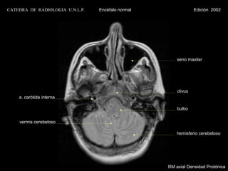 CATEDRA DE RADIOLOGIA U.N.L.P.   Encéfalo normal                Edición 2002




                                                       seno maxilar




                                                       clivus
    a. carótida interna

                                                       bulbo


    vermis cerebeloso

                                                       hemisferio cerebeloso




                                                   RM axial Densidad Protónica
 