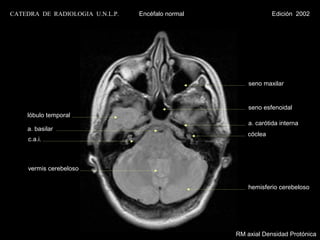 CATEDRA DE RADIOLOGIA U.N.L.P.   Encéfalo normal                Edición 2002




                                                       seno maxilar


                                                       seno esfenoidal
    lóbulo temporal
                                                       a. carótida interna
    a. basilar
                                                       cóclea
    c.a.i.



    vermis cerebeloso


                                                       hemisferio cerebeloso




                                                   RM axial Densidad Protónica
 