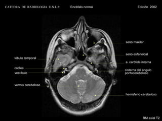 CATEDRA DE RADIOLOGIA U.N.L.P.   Encéfalo normal            Edición 2002




                                                   seno maxilar


                                                   seno esfenoidal
     lóbulo temporal
                                                   a. carótida interna
     cóclea
                                                   cisterna del ángulo
     vestíbulo                                     pontocerebeloso


     vermis cerebeloso


                                                   hemisferio cerebeloso




                                                               RM axial T2
 