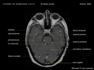 CATEDRA DE RADIOLOGIA U.N.L.P.   Encéfalo normal            Edición 2002




    hipófisis                                       lóbulo temporal
    asta temporal                                   cisterna pontina


    protuberancia
                                                    cisterna ambiens
    IV ventrículo


                                                    hemisferio cerebeloso


    lóbulo occipital


                                                    seno sagital


                                                   RM axial T1 con contraste
 