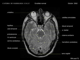CATEDRA DE RADIOLOGIA U.N.L.P.   Encéfalo normal            Edición 2002




     cristalino


                                                   celdillas etmoidales




     hipófisis                                     lóbulo temporal
     asta temporal
                                                   a. basilar

     protuberancia
                                                   cisterna ambiens
     IV ventrículo

     vermis cerebeloso
                                                   hemisferio cerebeloso


     lóbulo occipital


                                                   seno sagital


                                                                  RM axial T2
 