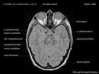 CATEDRA DE RADIOLOGIA U.N.L.P.   Encéfalo normal                Edición 2002




                                                      nervio óptico



a. cerebral media
                                                       a. carótida interna
cisterna supraselar


cist. interpenduncular                                 pedúnculo cerebral

 acueducto de Silvio

 vermis cerebeloso


 seno transverso


                                                       lóbulo occipital




                                                   RM axial Densidad Protónica
 