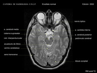 CATEDRA DE RADIOLOGIA U.N.L.P.   Encéfalo normal            Edición 2002




                                                   nervio óptico



a. cerebral media                                  a. carótida interna
cisterna supraselar
                                                   a. cerebral posterior
cist. interpenduncular                             pedúnculo cerebral

 acueducto de Silvio

 vermis cerebeloso


 seno transverso


                                                   lóbulo occipital




                                                                   RM axial T2
 