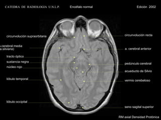 CATEDRA DE RADIOLOGIA U.N.L.P.   Encéfalo normal                Edición 2002




     circunvolución supraorbitaria                        circunvolución recta


a.cerebral media
 a.silviana)                                               a. cerebral anterior

     tracto óptico
     sustancia negra
                                                          pedúnculo cerebral
     núcleo rojo
                                                          acueducto de Silvio

     lóbulo temporal                                      vermis cerebeloso




     lóbulo occipital
                                                          seno sagital superior


                                                       RM axial Densidad Protónica
 