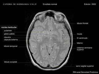 CATEDRA DE RADIOLOGIA U.N.L.P.   Encéfalo normal                Edición 2002




                                                        lóbulo frontal

núcleo lenticular
   putamen
   globo pálido                                         ínsula
   claustro                                             III ventrículo
   cápsula externa
                                                        tálamo
   lóbulo temporal
                                                        cisterna vermiana
                                                        superior




   lóbulo occipital

                                                       seno sagital superior


                                                    RM axial Densidad Protónica
 
