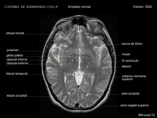 CATEDRA DE RADIOLOGIA U.N.L.P.   Encéfalo normal             Edición 2002




lóbulo frontal


                                                   cisura de Silvio

 putamen
globo pálido                                        ínsula
cápsula interna                                     III ventrículo
cápsula externa
                                                    tálamo

lóbulo temporal
                                                    cisterna vermiana
                                                    superior



                                                   asta occipital
 lóbulo occipital


                                                   seno sagital superior


                                                                 RM axial T2
 