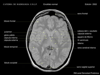 CATEDRA DE RADIOLOGIA U.N.L.P.   Encéfalo normal                Edición 2002



                                                      seno frontal


lóbulo frontal




 putamen                                              cabeza del n. caudado
                                                      cápsula externa
globo pálido
cápsula interna                                       agujero de Monro
cápsula externa                                        III ventrículo
                                                       tálamo
lóbulo temporal                                       vena cerebral interna




 lóbulo occipital

                                                      seno sagital superior


                                                   RM axial Densidad Protónica
 