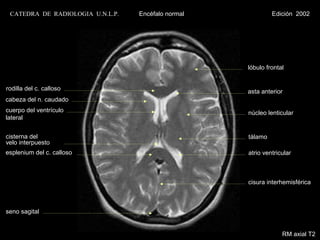CATEDRA DE RADIOLOGIA U.N.L.P.   Encéfalo normal            Edición 2002




                                                    lóbulo frontal


rodilla del c. calloso                              asta anterior
cabeza del n. caudado
cuerpo del ventrículo                               núcleo lenticular
lateral


cisterna del                                        tálamo
velo interpuesto
esplenium del c. calloso                            atrio ventricular



                                                    cisura interhemisférica



seno sagital


                                                                 RM axial T2
 