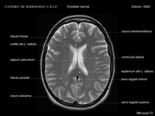CATEDRA DE RADIOLOGIA U.N.L.P.   Encéfalo normal           Edición 2002




                                                   cisura interhemisférica
   lóbulo frontal

   rodilla del c. calloso



                                                   ventrículo lateral
   septum pelucidum


                                                   esplenium del c. calloso

   lóbulo parietal                                 seno sagital inferior




   cisura calcarina

                                                   seno sagital superior


                                                               RM axial T2
 