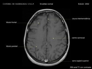 CATEDRA DE RADIOLOGIA U.N.L.P.   Encéfalo normal            Edición 2002




                                                     cisura interhemisférica

   lóbulo frontal




                                                     centro semioval



   lóbulo parietal




                                                     seno sagital superior


                                                   RM axial T1 con contraste
 