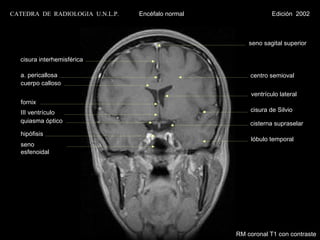 CATEDRA DE RADIOLOGIA U.N.L.P.   Encéfalo normal                Edición 2002



                                                       seno sagital superior

  cisura interhemisférica

  a. pericallosa                                       centro semioval
  cuerpo calloso
                                                        ventrículo lateral
  fornix
  III ventrículo                                       cisura de Silvio
  quiasma óptico                                       cisterna supraselar
  hipófisis
                                                        lóbulo temporal
  seno
  esfenoidal




                                                   RM coronal T1 con contraste
 