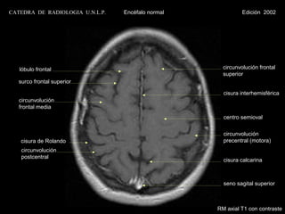 CATEDRA DE RADIOLOGIA U.N.L.P.   Encéfalo normal             Edición 2002




   lóbulo frontal                                    circunvolución frontal
                                                     superior
   surco frontal superior

                                                     cisura interhemisférica
   circunvolución
   frontal media
                                                     centro semioval


                                                     circunvolución
   cisura de Rolando                                 precentral (motora)
    circunvolución
    postcentral
                                                     cisura calcarina



                                                     seno sagital superior



                                                   RM axial T1 con contraste
 