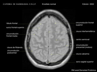 CATEDRA DE RADIOLOGIA U.N.L.P.   Encéfalo normal               Edición 2002




   lóbulo frontal                                      circunvolución frontal
                                                       superior
   surco frontal superior

                                                        cisura interhemisférica
   circunvolución
   frontal media
                                                        centro semioval


                                                        circunvolución
   cisura de Rolando                                    precentral (motora)
    circunvolución
    postcentral
                                                        cisura calcarina



                                                        seno sagital superior



                                                   RM axial Densidad Protónica
 