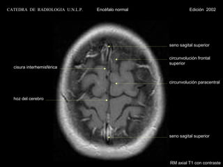 CATEDRA DE RADIOLOGIA U.N.L.P.   Encéfalo normal             Edición 2002




                                                   seno sagital superior


                                                   circunvolución frontal
                                                   superior
  cisura interhemisférica


                                                   circunvolución paracentral


  hoz del cerebro




                                                   seno sagital superior




                                                   RM axial T1 con contraste
 