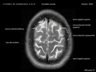 CATEDRA DE RADIOLOGIA U.N.L.P.   Encéfalo normal             Edición 2002




                                                   seno sagital superior


                                                   circunvolución frontal
                                                   superior
 cisura interhemisférica


                                                   circunvolución paracentral


  hoz del cerebro




                                                   seno sagital superior




                                                                 RM axial T2
 