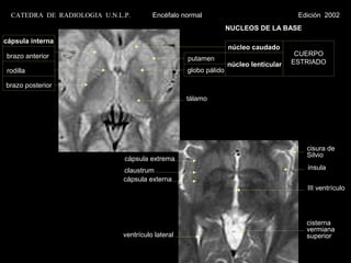 CATEDRA DE RADIOLOGIA U.N.L.P.        Encéfalo normal                                Edición 2002
                                                                  NUCLEOS DE LA BASE
cápsula interna
                                                                  núcleo caudado
brazo anterior                                                                         CUERPO
                                                   putamen                            ESTRIADO
                                                                  núcleo lenticular
rodilla                                            globo pálido

brazo posterior
                                                   tálamo




                                                                                         cisura de
                                                                                         Silvio
                              cápsula extrema
                              claustrum                                                  ínsula
                              cápsula externa
                                                                                         III ventrículo




                                                                                         cisterna
                                                                                         vermiana
                              ventrículo lateral                                         superior
 