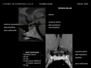 CATEDRA DE RADIOLOGIA U.N.L.P.              Encéfalo normal                           Edición 2002

                                                                    REGION SELAR


                                                      tálamo



                                                      quiasma óptico
cisterna supraselar                                   tallo hipofisario
 adenohipófisis                                       neurohipófisis
 seno esfenoidal




                          seno cavernoso                                           quiasma óptico
                      •carótida interna                                            tallo hipofisario
                      •III par
                                                                                   hipófisis
                      •IV par
                      •V par (rama oftálmica
                           y maxilar superior)                                     seno esfenoidal
                      •VI par
 