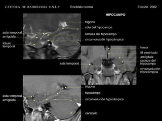 CATEDRA DE RADIOLOGIA U.N.L.P.      Encéfalo normal                       Edición 2002

                                                            HIPOCAMPO

                                              trígono
                                              cola del hipocampo
asta temporal                                 cabeza del hipocampo
amígdala
                                              circunvolución hipocámpica
lóbulo
temporal                                                                    fornix
                                                                            III ventrículo
                                                                            amígdala
                                                                            cabeza del
                              asta temporal                                 hipocampo
                                                                            circunvolución
                                                                            hipocámpica



                                              trígono

                                              hipocampo
asta temporal
amígdala                                      circunvolución hipocámpica



                                              cerebelo
 