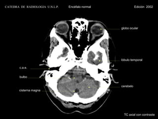 CATEDRA DE RADIOLOGIA U.N.L.P.   Encéfalo normal              Edición 2002




                                                   globo ocular




                                                   lóbulo temporal

        c.a.e.


        bulbo


                                                   cerebelo
       cisterna magna




                                                    TC axial con contraste
 
