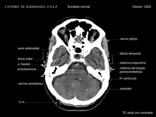 CATEDRA DE RADIOLOGIA U.N.L.P.   Encéfalo normal              Edición 2002




                                                   nervio óptico


       seno esfenoidal
                                                   lóbulo temporal
       dorso selar
       a. basilar                                  cisterna prepontina

       protuberancia                               cisterna del ángulo
                                                   pontocerebeloso

                                                   IV ventrículo
       vermis cerebeloso
                                                   cerebelo



       t.c.s.


                                                     TC axial con contraste
 