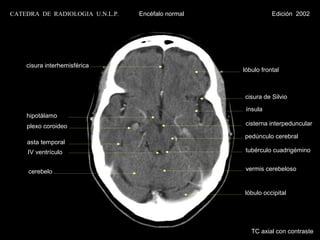 CATEDRA DE RADIOLOGIA U.N.L.P.   Encéfalo normal              Edición 2002




    cisura interhemisférica
                                                   lóbulo frontal



                                                   cisura de Silvio
                                                    ínsula
    hipotálamo
    plexo coroideo                                 cisterna interpeduncular

                                                   pedúnculo cerebral
    asta temporal
    IV ventrículo                                  tubérculo cuadrigémino


     cerebelo                                       vermis cerebeloso


                                                   lóbulo occipital




                                                      TC axial con contraste
 