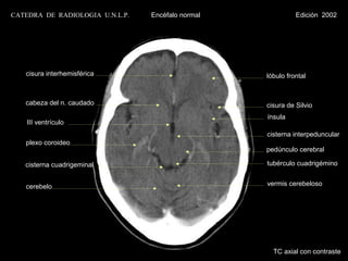 CATEDRA DE RADIOLOGIA U.N.L.P.   Encéfalo normal             Edición 2002




   cisura interhemisférica                         lóbulo frontal


   cabeza del n. caudado                           cisura de Silvio
                                                   ínsula
    III ventrículo
                                                   cisterna interpeduncular
   plexo coroideo
                                                   pedúnculo cerebral

   cisterna cuadrigeminal                          tubérculo cuadrigémino


   cerebelo                                        vermis cerebeloso




                                                     TC axial con contraste
 