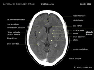 CATEDRA DE RADIOLOGIA U.N.L.P.   Encéfalo normal                 Edición 2002




                                                       hoz del cerebro

   cisura interhemisférica                             lóbulo frontal

   cuerpo calloso
                                                       asta frontal
   cabeza del n. caudado
                                                       brazo anterior
   núcleo lenticular                                                     cápsula
   cápsula externa                                     rodilla           interna
                                                       brazo posterior
    III ventrículo
                                                       tálamo

   plexo coroideo


                                                       vermis cerebeloso




                                                   lóbulo occipital



                                                        TC axial con contraste
 