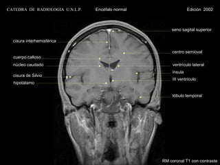 CATEDRA DE RADIOLOGIA U.N.L.P.   Encéfalo normal                Edición 2002



                                                       seno sagital superior

  cisura interhemisférica

                                                       centro semioval
  cuerpo calloso
  núcleo caudado                                        ventrículo lateral
                                                       ínsula
  cisura de Silvio
                                                        III ventrículo
  hipotálamo


                                                        lóbulo temporal




                                                   RM coronal T1 con contraste
 