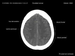 CATEDRA DE RADIOLOGIA U.N.L.P.   Encéfalo normal              Edición 2002




       hoz del cerebro
                                                   lóbulo frontal



    centro semioval




                                                    lóbulo parietal




                                                      TC axial con contraste
 