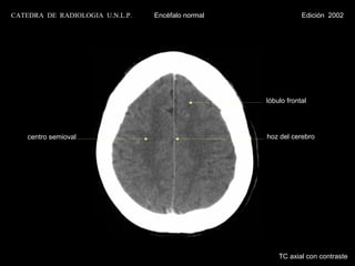 CATEDRA DE RADIOLOGIA U.N.L.P.   Encéfalo normal               Edición 2002




                                                   lóbulo frontal




    centro semioval                                hoz del cerebro




                                                       TC axial con contraste
 