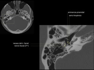 eminencia piramidal
                          seno timpánico




receso del n. facial
  nervio facial (3era)
 