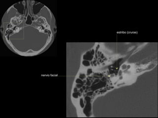 estribo (cruras)




nervio facial
 