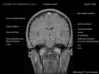 CATEDRA DE RADIOLOGIA U.N.L.P.   Encéfalo normal                Edición 2002



                                                       seno sagital superior

  cisura interhemisférica

                                                       centro semioval
  cuerpo calloso
                                                        ventrículo lateral
  cisura de Silvio                                     ínsula
                                                        III ventrículo
  fosa interpeduncular                                 pedúnculo cerebral
  lóbulo temporal                                      circunvol. del hipocampo
  V par
                                                       c.a.i.
                                                       c.a.e
                                                       .




                                                   RM coronal T1 con contraste
 