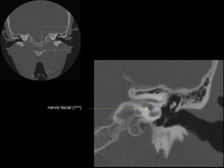 nervio facial (1era)
 