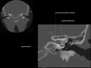 conducto auditivo interno



                     cresta falciforme




promontorio
 