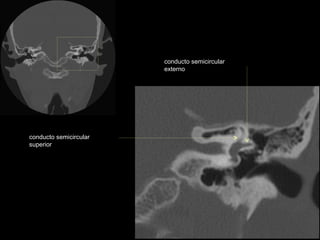 conducto semicircular
                        externo




conducto semicircular
superior
 