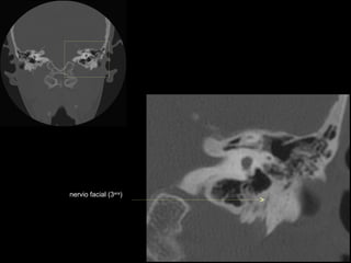 nervio facial (3era)
 