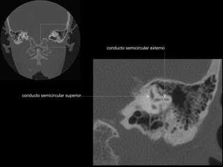 conducto semicircular externo




conducto semicircular superior
 