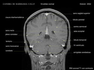 CATEDRA DE RADIOLOGIA U.N.L.P.   Encéfalo normal                Edición 2002




                                                       seno sagital superior

  cisura interhemisférica
                                                       lóbulo parietal


                                                       centro semioval

  seno recto                                            asta occipital
  plexo coroideo


                                                        lóbulo temporal
  tentorio

  seno transverso                                       IV ventrículo


  cerebelo
                                                       amígdala cerebelosa




                                                   RM coronal T1 con contraste
 