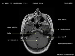 CATEDRA DE RADIOLOGIA U.N.L.P.   Encéfalo normal            Edición 2002




                                                    seno maxilar




     lóbulo temporal
                                                    a. carótida interna

     bulbo

                                                    seno lateral

      vermis cerebeloso

                                                    hemisferio cerebeloso




                                                   RM axial T1 con contraste
 