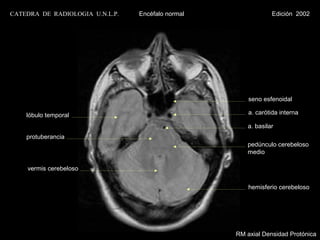 CATEDRA DE RADIOLOGIA U.N.L.P.   Encéfalo normal                Edición 2002




                                                       seno esfenoidal

    lóbulo temporal                                    a. carótida interna

                                                       a. basilar
    protuberancia
                                                      pedúnculo cerebeloso
                                                      medio

    vermis cerebeloso


                                                       hemisferio cerebeloso




                                                   RM axial Densidad Protónica
 