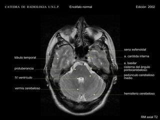 CATEDRA DE RADIOLOGIA U.N.L.P.   Encéfalo normal           Edición 2002




                                                   seno esfenoidal

     lóbulo temporal                               a. carótida interna

                                                   a. basilar
     protuberancia                                 cisterna del ángulo
                                                   pontocerebeloso
                                                   pedúnculo cerebeloso
     IV ventrículo                                 medio


     vermis cerebeloso
                                                   hemisferio cerebeloso




                                                               RM axial T2
 