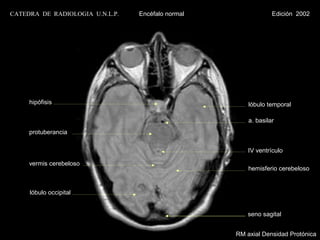 CATEDRA DE RADIOLOGIA U.N.L.P.   Encéfalo normal                Edición 2002




     hipófisis                                         lóbulo temporal

                                                       a. basilar
     protuberancia

                                                       IV ventrículo

     vermis cerebeloso
                                                       hemisferio cerebeloso


     lóbulo occipital


                                                       seno sagital


                                                   RM axial Densidad Protónica
 