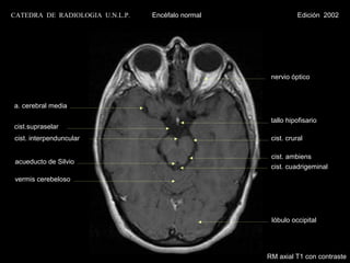 CATEDRA DE RADIOLOGIA U.N.L.P.   Encéfalo normal              Edición 2002




                                                    nervio óptico



a. cerebral media

                                                    tallo hipofisario
cist.supraselar
cist. interpenduncular                              cist. crural

                                                    cist. ambiens
 acueducto de Silvio
                                                    cist. cuadrigeminal
 vermis cerebeloso




                                                    lóbulo occipital




                                                   RM axial T1 con contraste
 