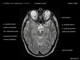 CATEDRA DE RADIOLOGIA U.N.L.P.   Encéfalo normal            Edición 2002




                                                   nervio óptico



a. cerebral media                                  a. carótida interna
cisterna supraselar
                                                   a. cerebral posterior
cist. interpenduncular                             pedúnculo cerebral

 acueducto de Silvio

 vermis cerebeloso




                                                   lóbulo occipital




                                                                   RM axial T2
 