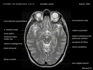 CATEDRA DE RADIOLOGIA U.N.L.P.   Encéfalo normal           Edición 2002




circunvolución supraorbitaria                      circunvolución recta




a. cerebral media                                  cisterna supraselar
 tracto óptico
sustancia negra                                    cisterna interpeduncular
núcleo rojo                                        pedúnculo cerebral

                                                   acueducto de Silvio
cisterna cuadrigeminal
                                                   vermis cerebeloso
lóbulo temporal




lóbulo occipital

                                                   seno sagital superior

                                                               RM axial T2
 